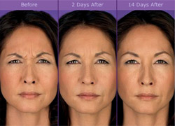 Botox in Chevy Chase, MD