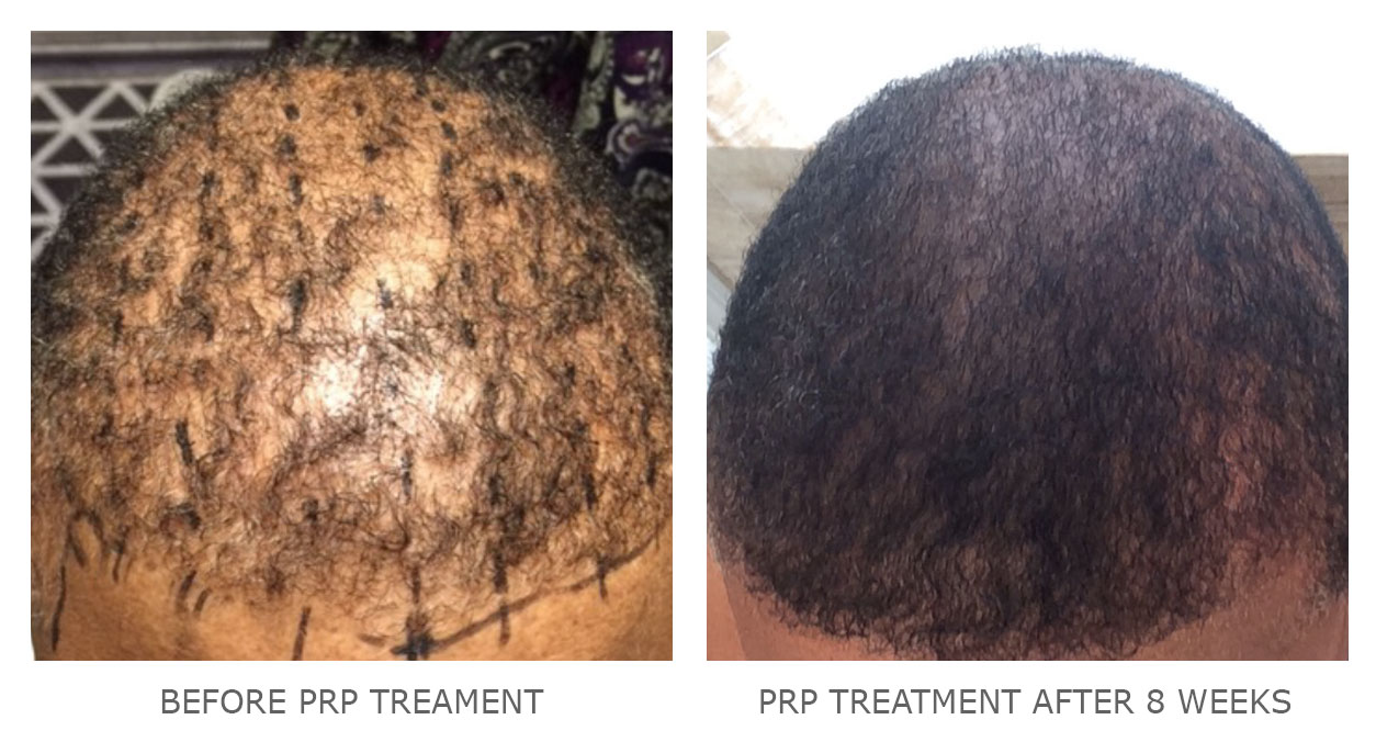 PRP for Hair Restoration - Dermatologist in Bethesda, MD