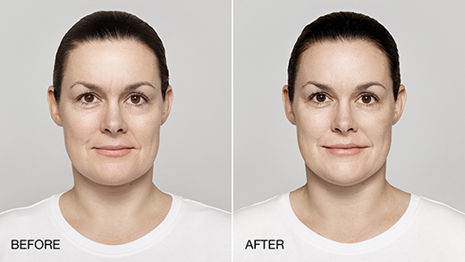 38 year old female treated with restylane Lyft